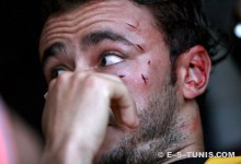 Les traces des crampons bien visibles sur le visage de Kamel Zaïem. (Photo CHALA)